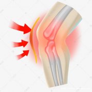 膝关节炎的保健方法是什么呢