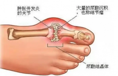 脚上有痛风石怎么消除？南京专治痛风有哪些医院？